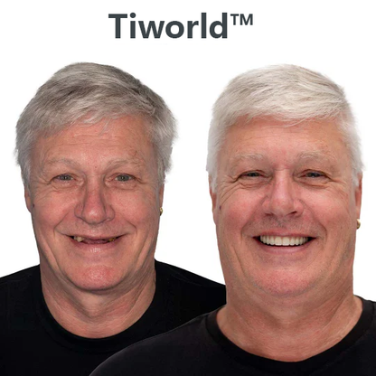 😁 Ends Today: 70% OFF! Tiworld™ Custom-Fit Full Functional DenturesMake you more confident – Made in the USA & FDA-Certified
